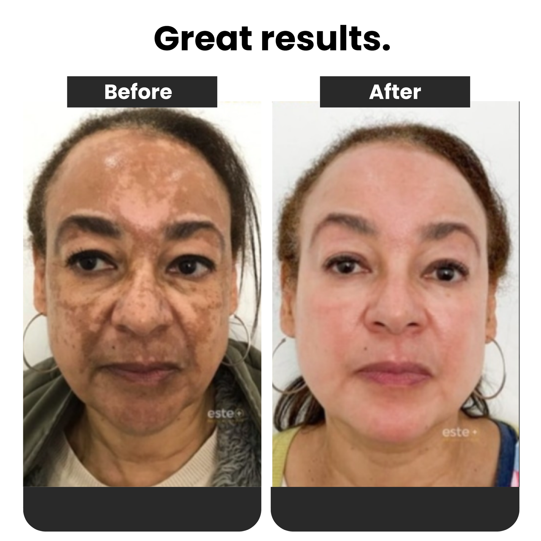 Dark Spot and Melasma Remover Spray 577