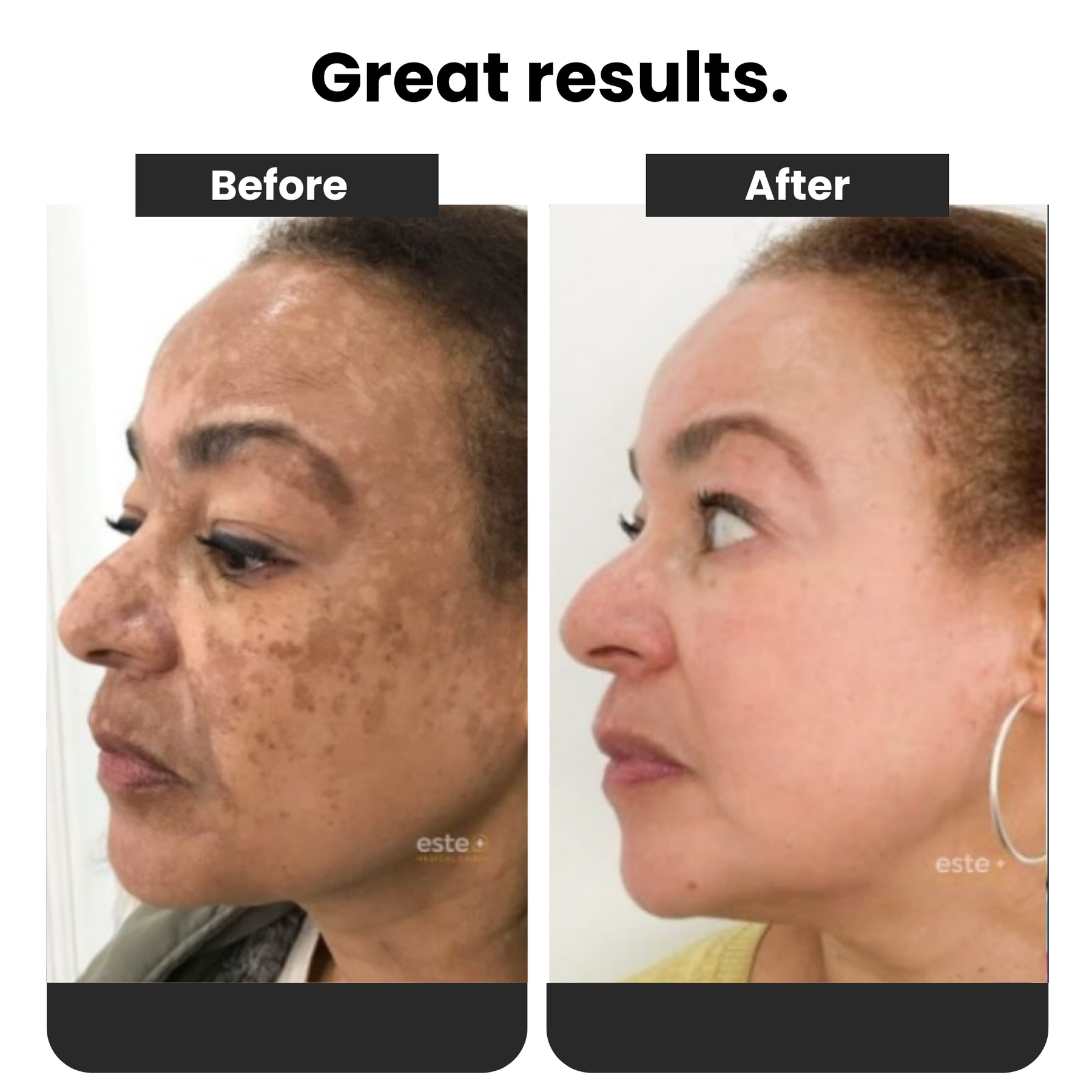 Dark Spot and Melasma Remover Spray 577
