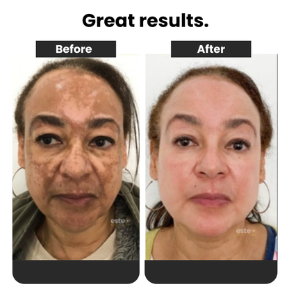 Spray 577 - Dark Spot Remover